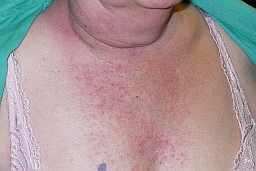 burnt lump red neck